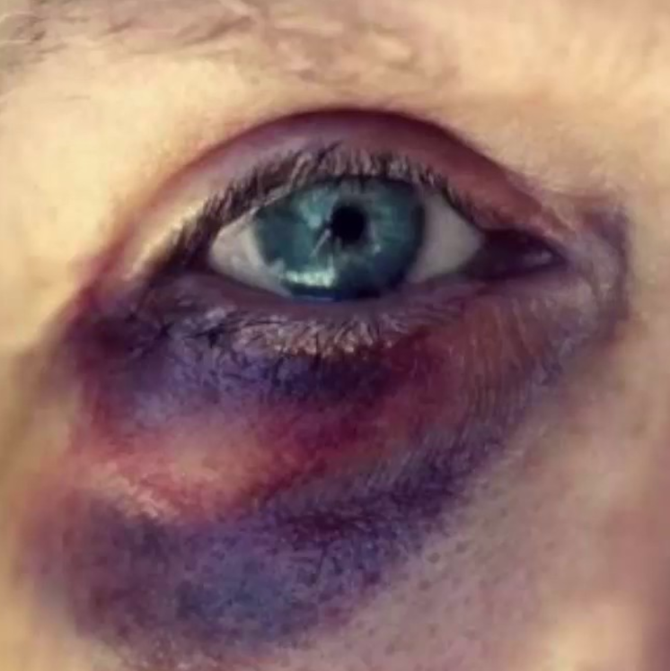 Causes of shop a black eye